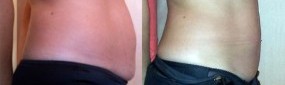 Brzuch - przed i po zabiegu Cavi-Lipo